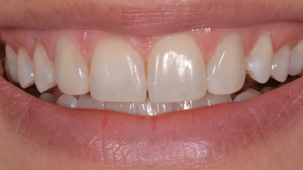 tandarts haarlem bleken facings